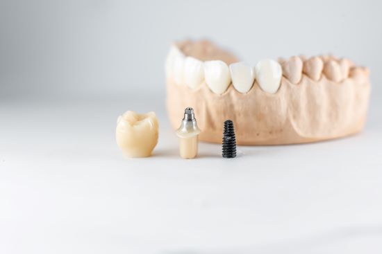 implantati, zubni implantati, ugradnja implantata